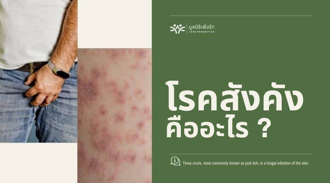 สังคัง (เชื้อราขาหนีบ): อาการ วิธีรักษาและป้องกันซ้ำ